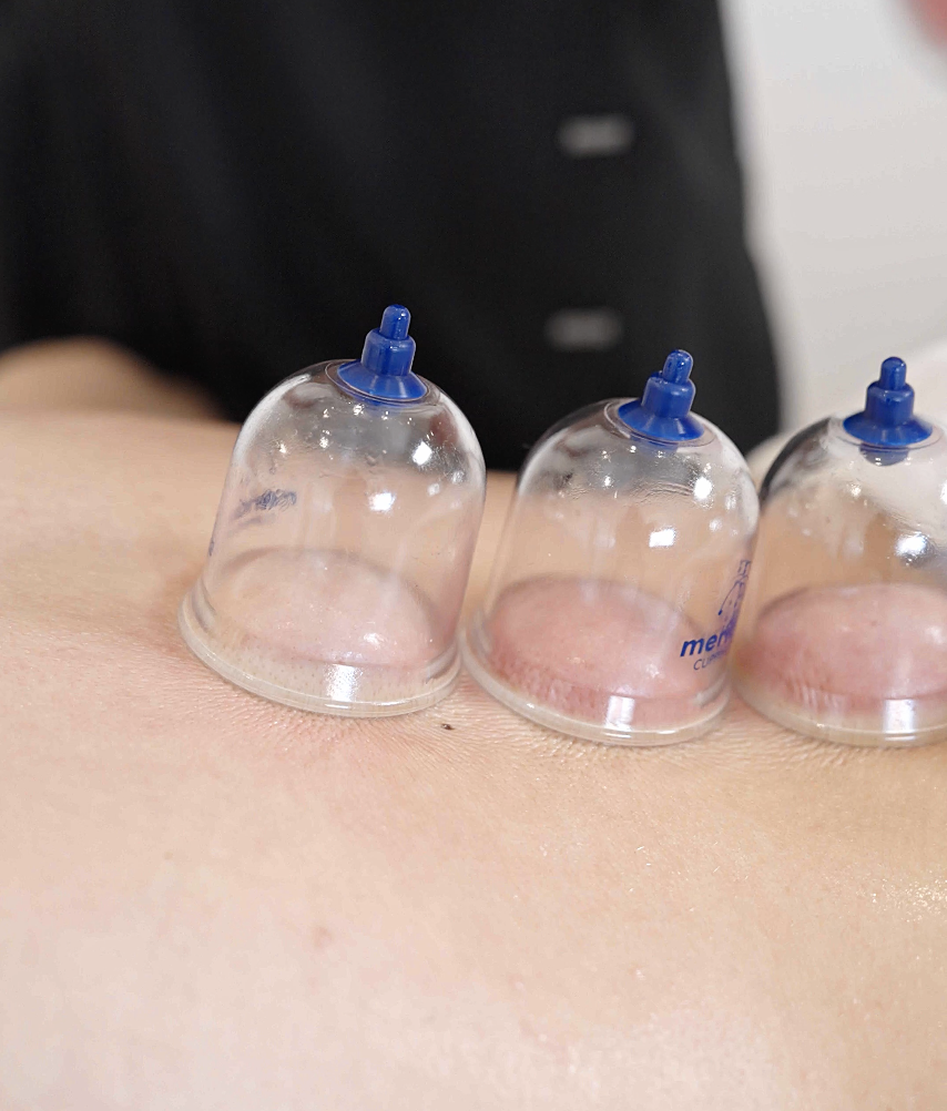 Cupping